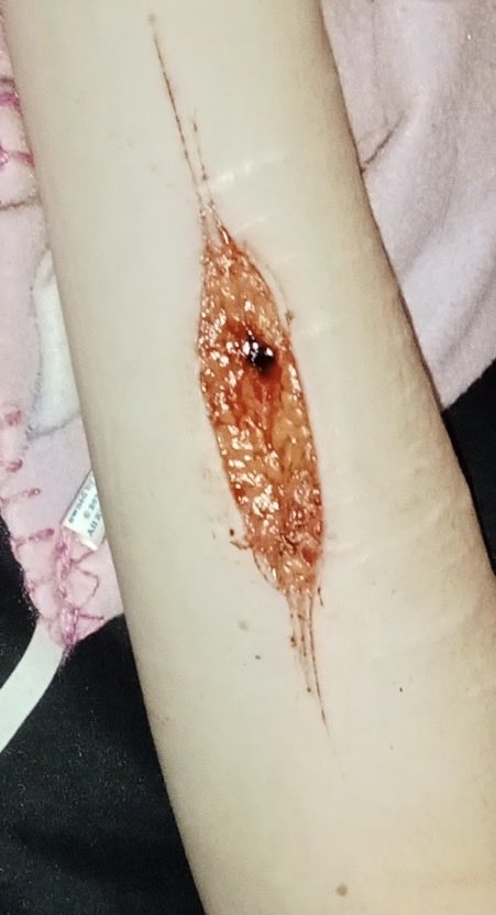 d1gitallenigma's tweet photo. Healing update on the vertical wrist cut I did abit ago ^^ #shtwt https://t.co/7xN4iB8z4Z
