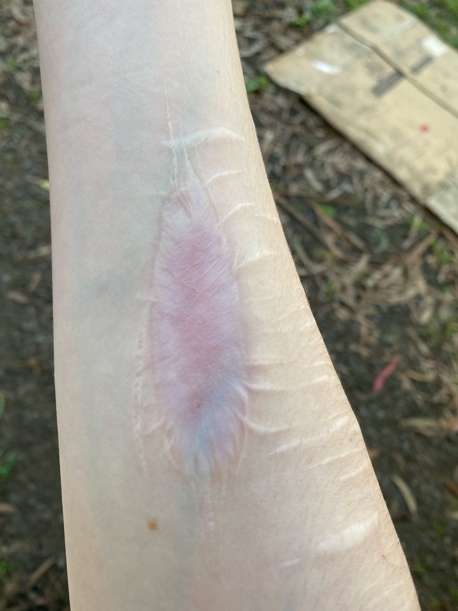 d1gitallenigma's tweet photo. Healing update on the vertical wrist cut I did abit ago ^^ #shtwt https://t.co/7xN4iB8z4Z