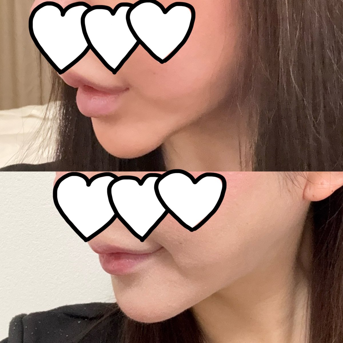 i_erre's tweet photo. 魔女顎手術してもうすぐ2ヶ月
腫れははもうだいぶ落ちついて
違和感もそんなにない感じ
ライトの関係で肌の色が違うけど
顎短くなったと思います傷跡は
まだ結構残ってるからケア頑張る

#リチャム美容外科　#魔女顎 https://t.co/0X5SCB9jtx