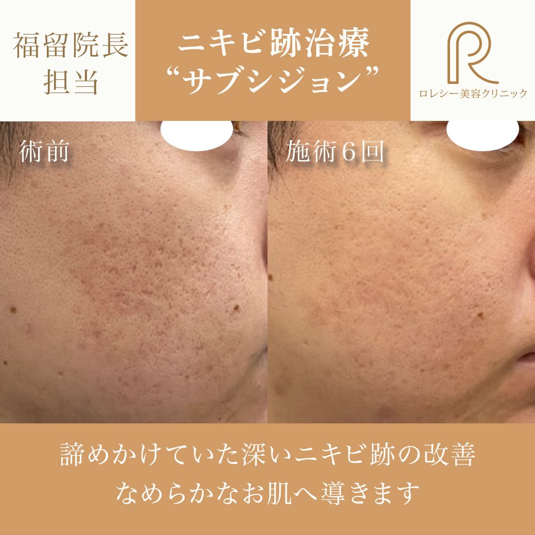 rolecy0605's tweet photo. 【サブシジョンの症例】
深く凹んだニキビ跡（クレーター）を内側から持ち上げる！サブシジョン6回の症例になります。

ニキビ跡の治療
サブシジョンについて詳しく↓
https://t.co/ZikmYn47Zx https://t.co/X1EXExT5B1