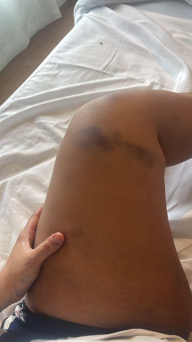 Mostrando o que a ansiedade é capaz de fazer no corpo.