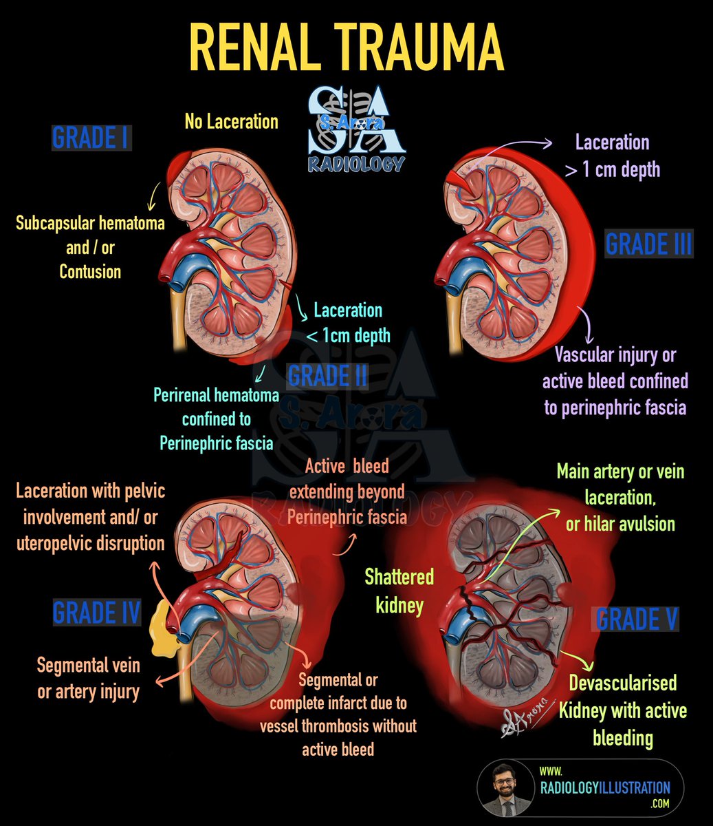 Dr_S_Arora's tweet photo. Slide on renal trauma.

#radiologyillustration https://t.co/HTV7cDEOgy