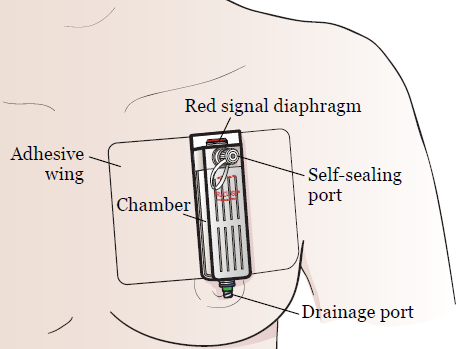 Just learned about Thoracic Vents from The Pitt.

ThoraVent is a small, portable device for pneumothorax that lets patients walk around, even go home.

It's a game-changer. 

Well, in African setting, chest tubes are still king.