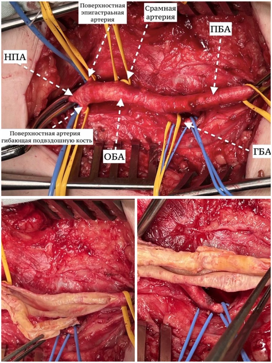 NikitoS888's tweet photo. Calcified lesions of the lower extremity arteries in patients with #CLTI #LimbSalvageCenter https://t.co/ea3CkxkC3r