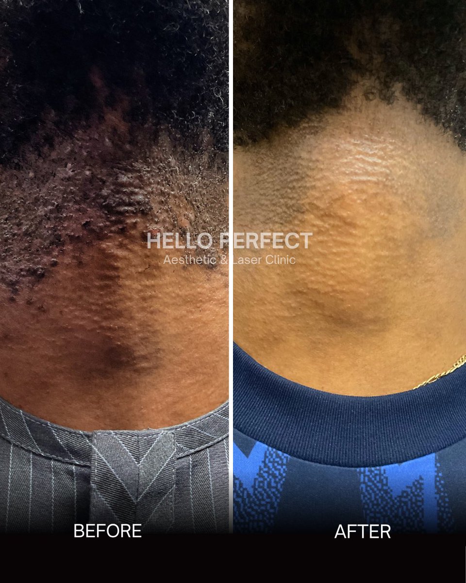 Helloperfect_'s tweet photo. Progressive reduction in lesion count, inflammation, and recurrence was observed.

Laser therapy remains a clinically effective approach for long term management. https://t.co/mNWUtVGY9f