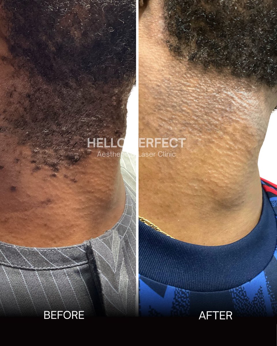 Helloperfect_'s tweet photo. Pseudofolliculitis barbae is a chronic inflammatory condition driven by hair re-entry into the skin.

Treatment protocol: 7 sessions of laser removal conducted over a 28-week period. https://t.co/tfsfHu0Rqf