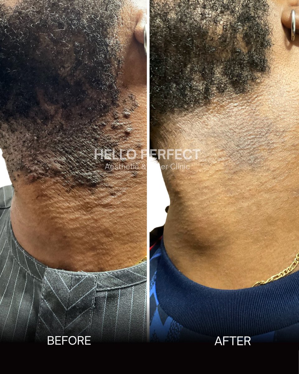 Helloperfect_'s tweet photo. Pseudofolliculitis barbae is a chronic inflammatory condition driven by hair re-entry into the skin.

Treatment protocol: 7 sessions of laser removal conducted over a 28-week period. https://t.co/tfsfHu0Rqf