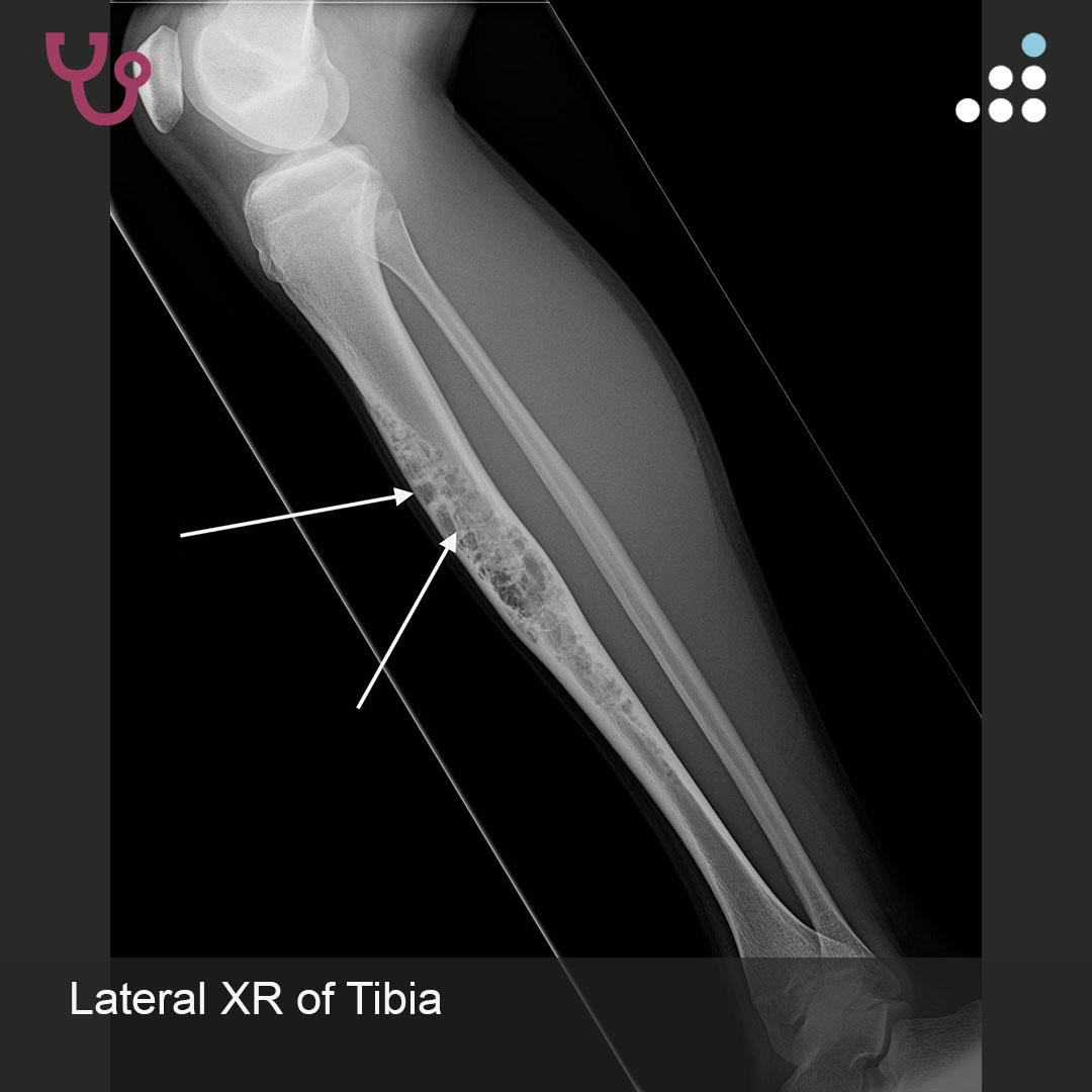 orthobullets's tweet image. Here is a new case by @DrJamesWittig and Mandala Medical Group.

SHIN PAIN AND SWELLING IN 13M

How would you manage this #orthotwitter?

Vote on this case for CME: orthobullets.tiny.us/2s3nbkwx
