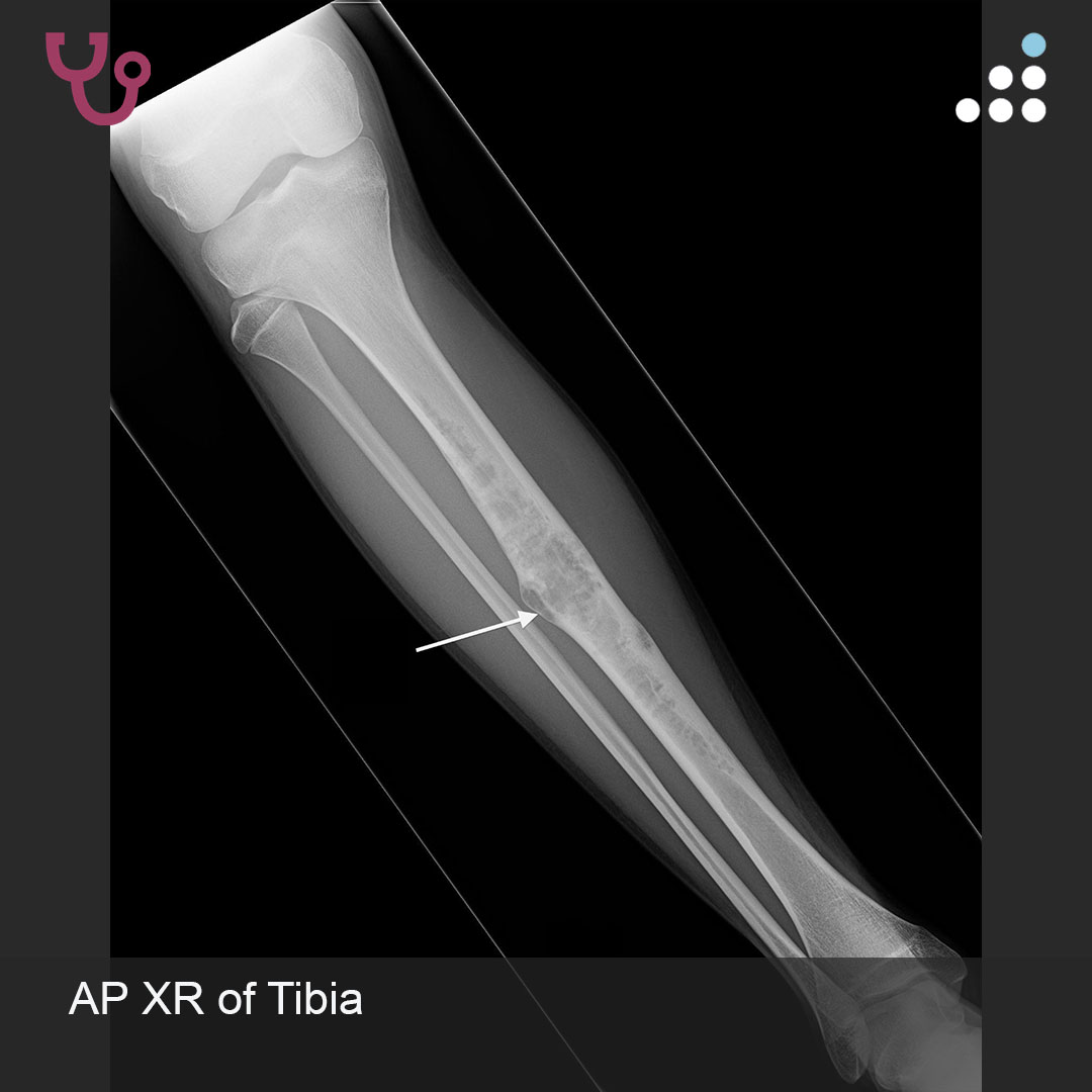 orthobullets's tweet image. Here is a new case by @DrJamesWittig and Mandala Medical Group.

SHIN PAIN AND SWELLING IN 13M

How would you manage this #orthotwitter?

Vote on this case for CME: orthobullets.tiny.us/2s3nbkwx