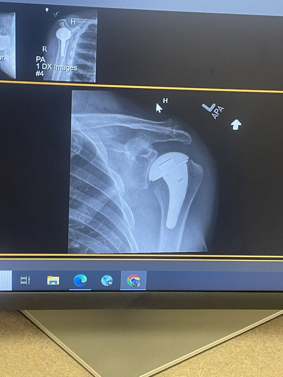 RaulAllegre's tweet image. No había jugado golf desde que me pusieron la prótesis en el hombro. Me invitaron a un torneo de beneficencia el viernes y fui a ver como respondía. En Top Golf pusieron unos postes de gol de campo. No me fue mal.
#fieldgoal #golf