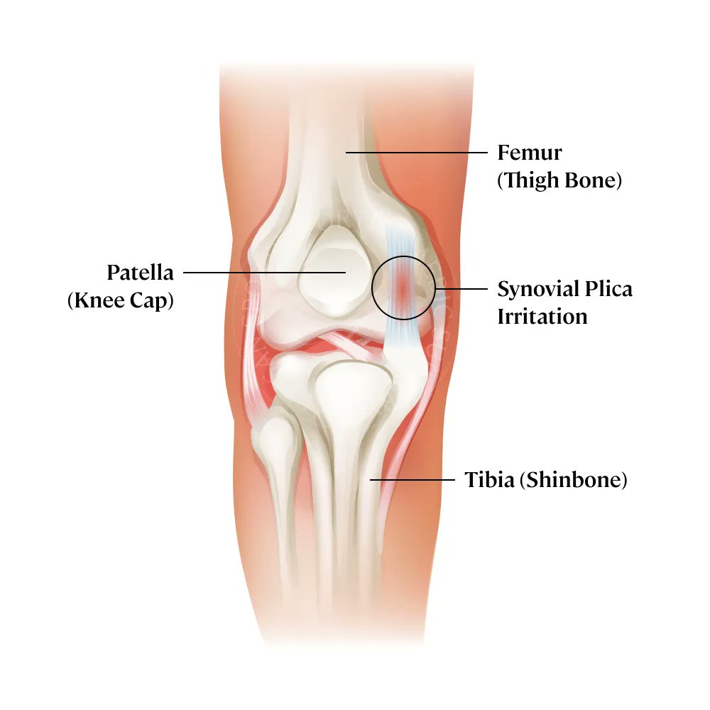 The suprapatellar plica is a synovial fold located within the suprapatellar pouch of the knee, representing a remnant of embryologic septation between the joint cavity and suprapatellar bursa. Functionally, it typically has little to no role in normal knee mechanics, though it