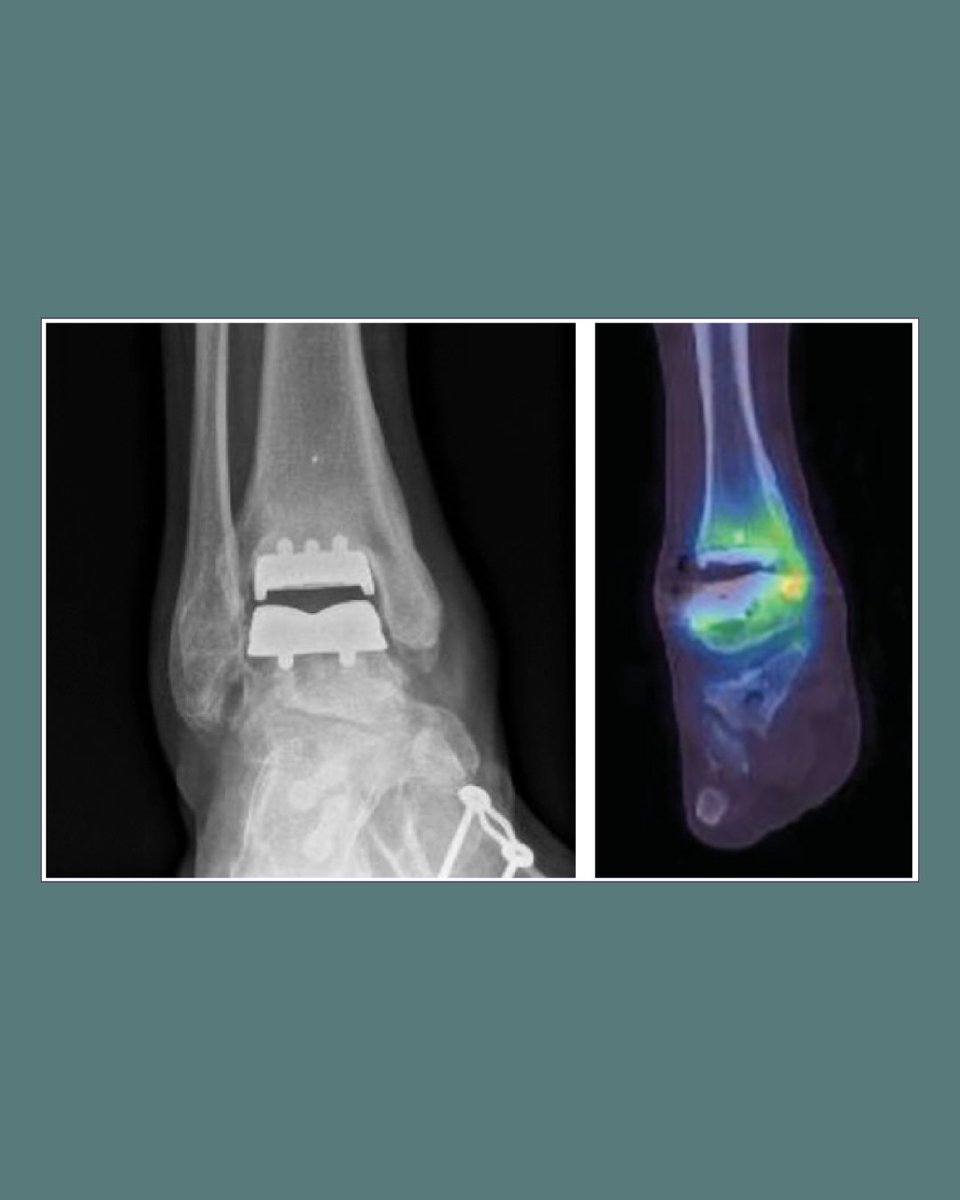 BoneJointJ's tweet photo. As total ankle arthroplasty becomes an increasingly common treatment for end-stage ankle arthritis, managing failing implants is becoming a growing challenge for orthopaedic surgeons.

#TAA #TotalAnkleArthroplasty #AnkleArthritis 

https://t.co/Hy3NiOphhm https://t.co/muwBOI907j