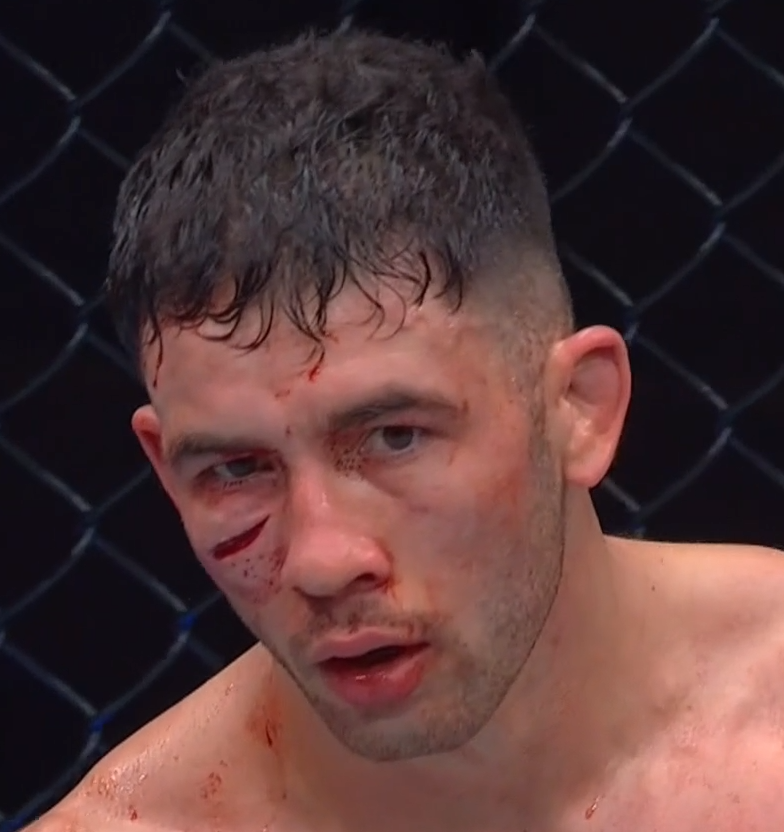 damienfarronMMA's tweet image. Axel Sola has a nasty cut. #UFCLondon