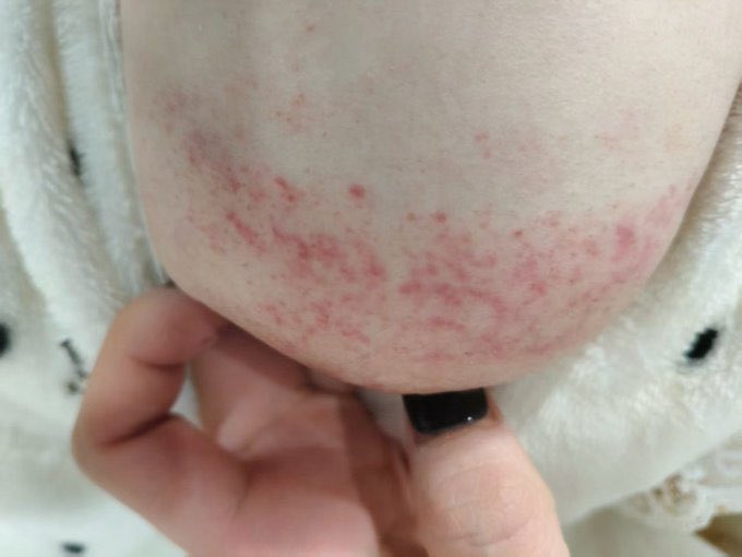 Es muy irritante, puedes curarlo? 😭