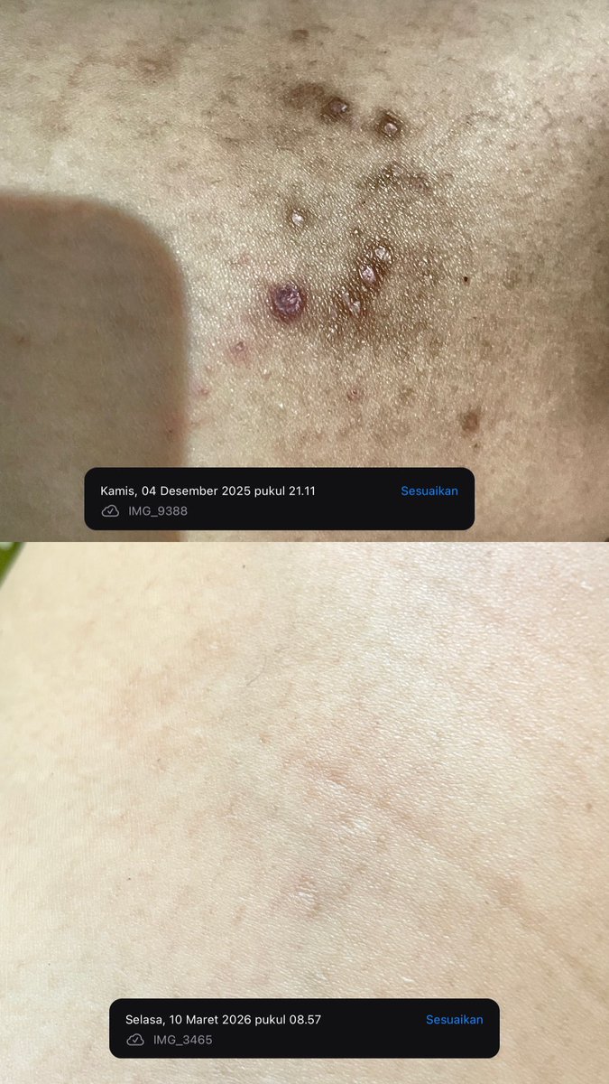 No instant results, but my body skin slowly feels healthier and well treated.