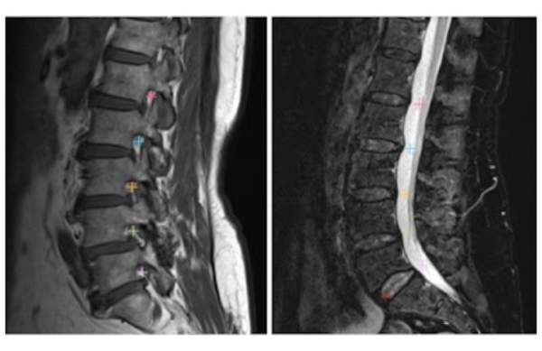 lX3Z447rzPfp7IM's tweet photo. Introducing the LumbarDISC Dataset, the largest publicly available adult MRI lumbar spine dataset for degenerative disease https://t.co/VrdHjKFscj  #DataResources #dataset #MachineLearning https://t.co/VF4iTSJGRX