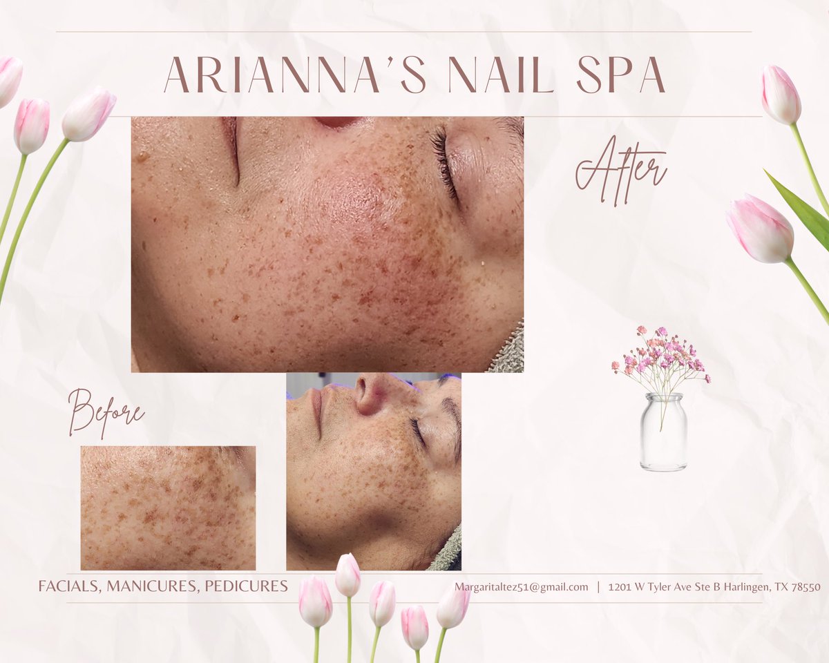 I had a hidrofacial done by Yohanna at Arianna’s Nail Spa and it was amazing. I have very dry skin and rosacea and I left with my skin super moisturized, bright and refreshed. It’s been a few days and my skin still feels amazing #hidrofacial #esthetician #facials #spa #esthetics