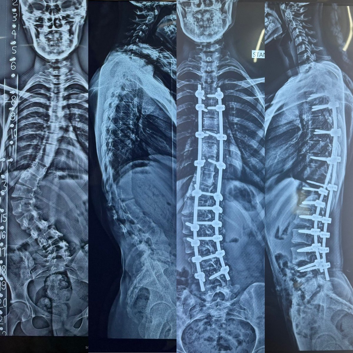 18 years old girl having deformity of back which progressed over last 3 years now having back pain. #Medtwitter #Orthotwitter #scoliosis
