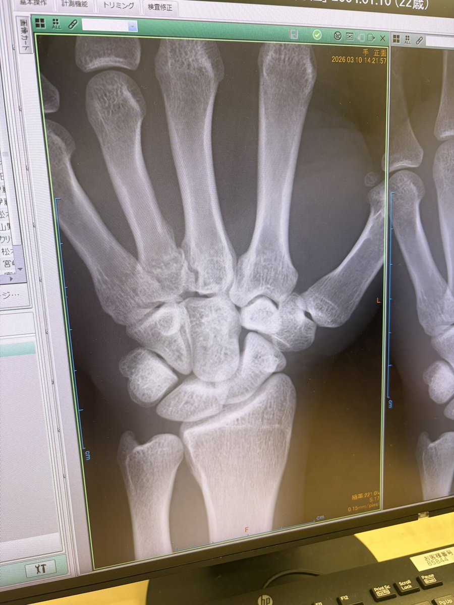 レントゲン写真を見てもまったくもって何が何だかわかりませんが試合で左手中手骨骨折してました。
この期間でもっと強くなるので楽しみにしててください！

#骨折 #怪我 #格闘家