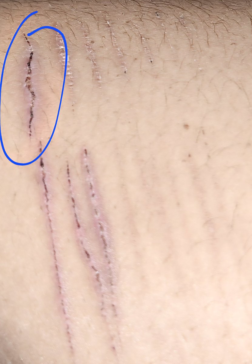 Mutis, esa se está infectando vdd? Vine a mear y lo vi así, estos días me ha dolido cualquier mínimo roce y se siente algo caliente cuando la toco T__T #shtw #subtwt