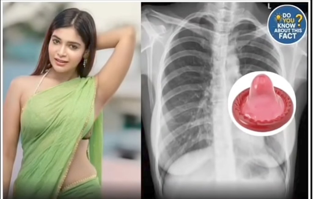 डॉक्टर भी रह गए हैरान सांस लेने में तकलीफ लेकर पहुंची महिला जांच में जो निकला, किसी ने सोचा भी नहीं था।

उत्तर प्रदेश की एक महिला टीवी जैसे लक्षणों के साथ अस्पताल पहुंची। शुरुआत में डॉक्टरों को लगा कि मामला सामान्य संक्रमण का है।

लेकिन जब एक्स-रे किया गया तो जांच में पता चला कि