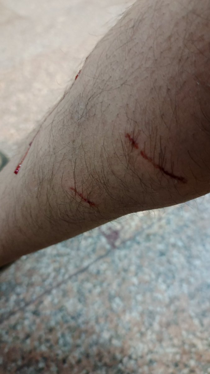 AnkitManiTiwar9's tweet photo. On the night of 9 March, near Platform No. 1 flyover at Indore Junction, I was bitten by stray dogs while simply walking and searching for a room. I am attaching photos of the injuries and medical reports. https://t.co/jnoJU436Mw