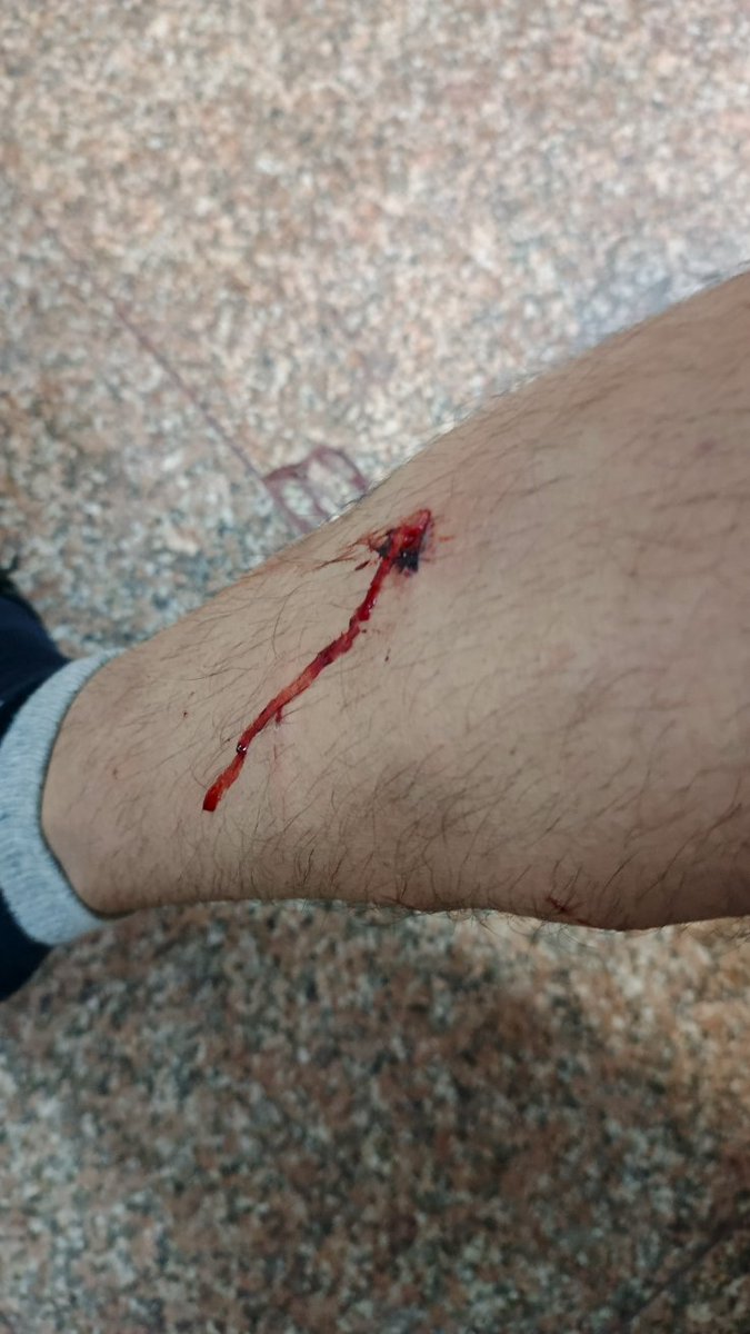 AnkitManiTiwar9's tweet photo. On the night of 9 March, near Platform No. 1 flyover at Indore Junction, I was bitten by stray dogs while simply walking and searching for a room. I am attaching photos of the injuries and medical reports. https://t.co/jnoJU436Mw