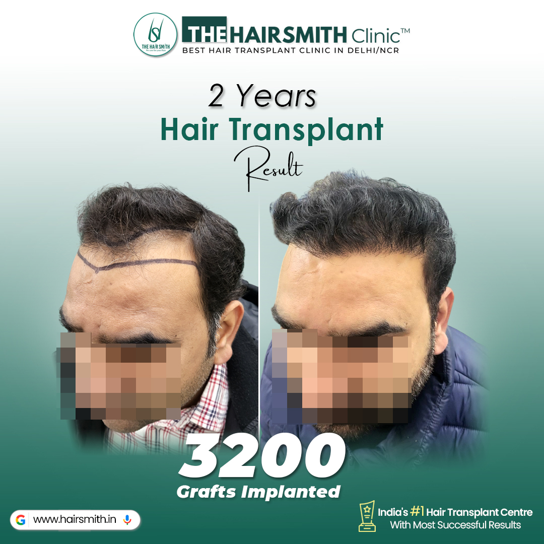 TheHairsmith's tweet photo. ✅ Results Speak Louder Than Words

📩 Book your consultation
📲 𝗪𝗵𝗮𝘁𝘀𝗔𝗽𝗽: +𝟵𝟭 𝟵𝟵𝟵𝟵𝟰𝟴𝟭𝟴𝟳𝟴 / 𝟵𝟴
🌐 https://t.co/erITzJVVZ6

#HairTransplantResults #HairsmithHairTransplant #HairsmithHairTransplantResults #TheHairsmithClinic https://t.co/Rz6hcAvt3M