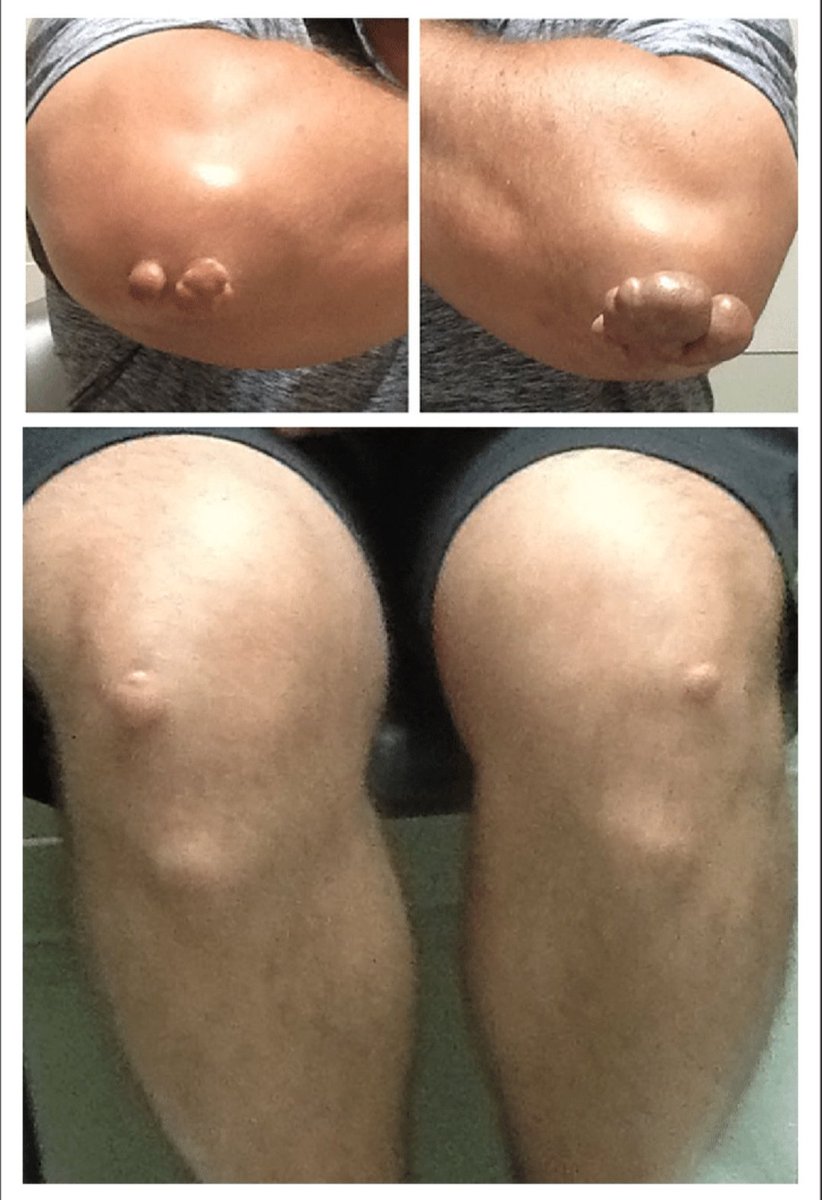 <a href="/hemo_shk/">Dr.Haitham Hamoud | د.هيثم</a> Multiple yellow nodules on the elbows and knees represent ✅Tuberous Xanthomas, typically associated with severe hyperlipidaemia, especially familial hypercholesterolaemia or type III hyperlipoproteinaemia, and they indicate significantly increased cardiovascular risk requiring