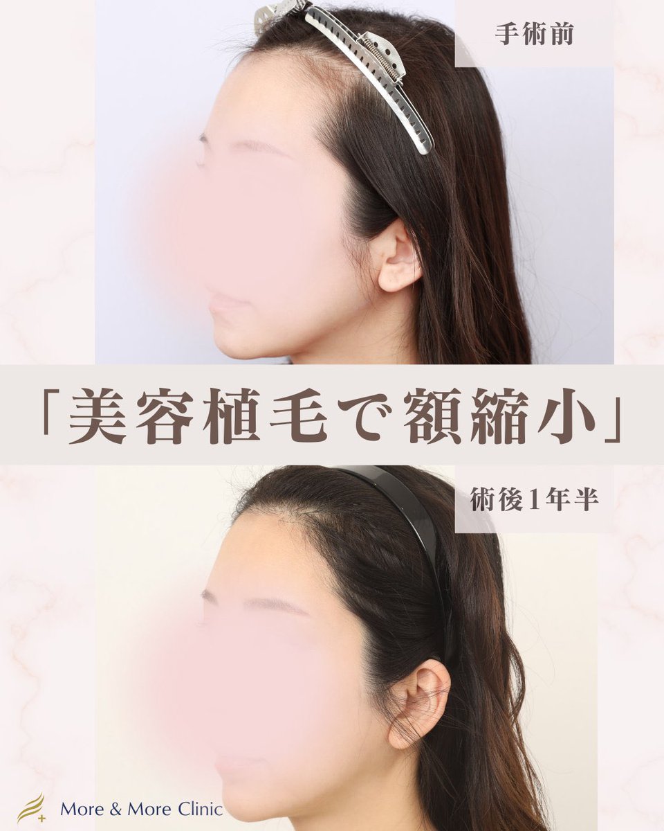 moamoclinic's tweet photo. 日本ではあまり広まっていませんが、韓国のアイドルや女優たちはかなりの確率で「美容植毛手術」で整えています。韓国現地で支持されていた🇺🇸毛髪外科学会専門医である韓国出身の院長が日本に開院しています。皆様の理想のヘアラインぜひご相談ください。 https://t.co/1sCPf2C8hl