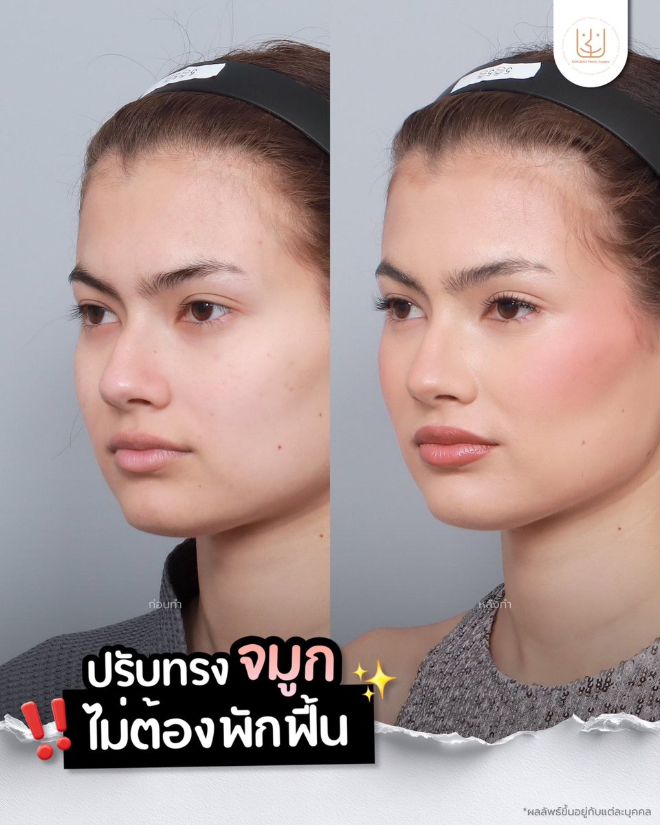 banobagithai's tweet photo. รีวิวปรับสันจมูกบริเวณฮัมพ์ 🫧✨
เติมเล็กน้อย แต่ทรงดูละมุนขึ้นอย่างเป็นธรรมชาติ~🤭

#ฟิลเลอร์คอลลาเจน #ปรับสันจมูก #แก้ฮัมพ์จมูก #จมูกละมุน
#ปรับรูปหน้า #งานปรึกษาศัลยกรรม #ศัลยกรรมเกาหลี https://t.co/yVZSoJySjE