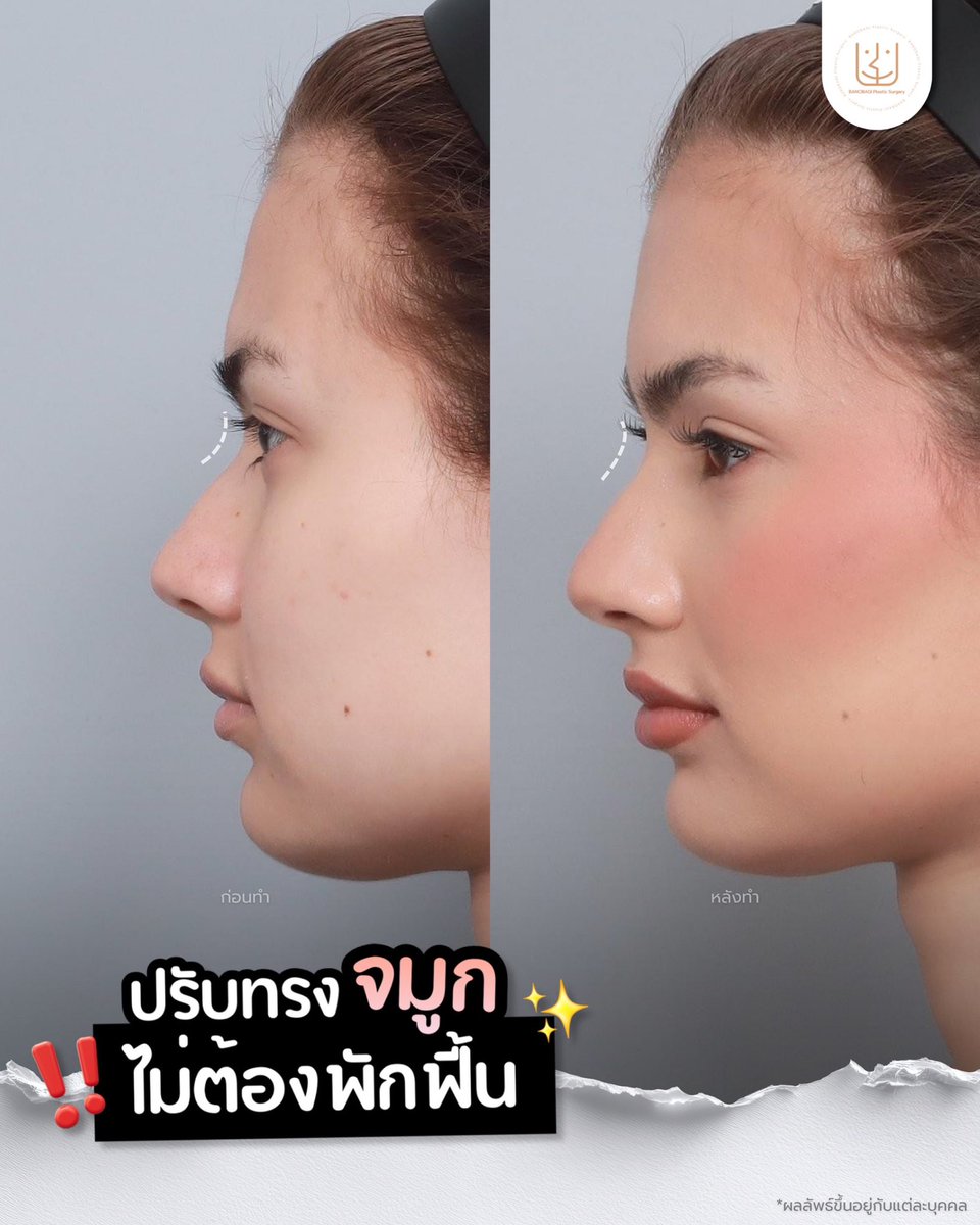 banobagithai's tweet photo. รีวิวปรับสันจมูกบริเวณฮัมพ์ 🫧✨
เติมเล็กน้อย แต่ทรงดูละมุนขึ้นอย่างเป็นธรรมชาติ~🤭

#ฟิลเลอร์คอลลาเจน #ปรับสันจมูก #แก้ฮัมพ์จมูก #จมูกละมุน
#ปรับรูปหน้า #งานปรึกษาศัลยกรรม #ศัลยกรรมเกาหลี https://t.co/yVZSoJySjE
