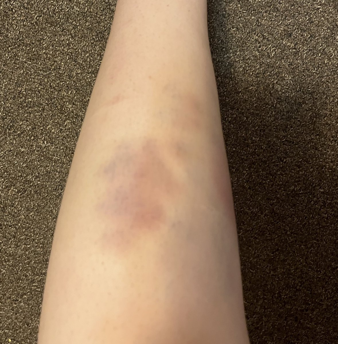 r__x0r's tweet photo. bruising
shtwt https://t.co/lj6PXCor0q