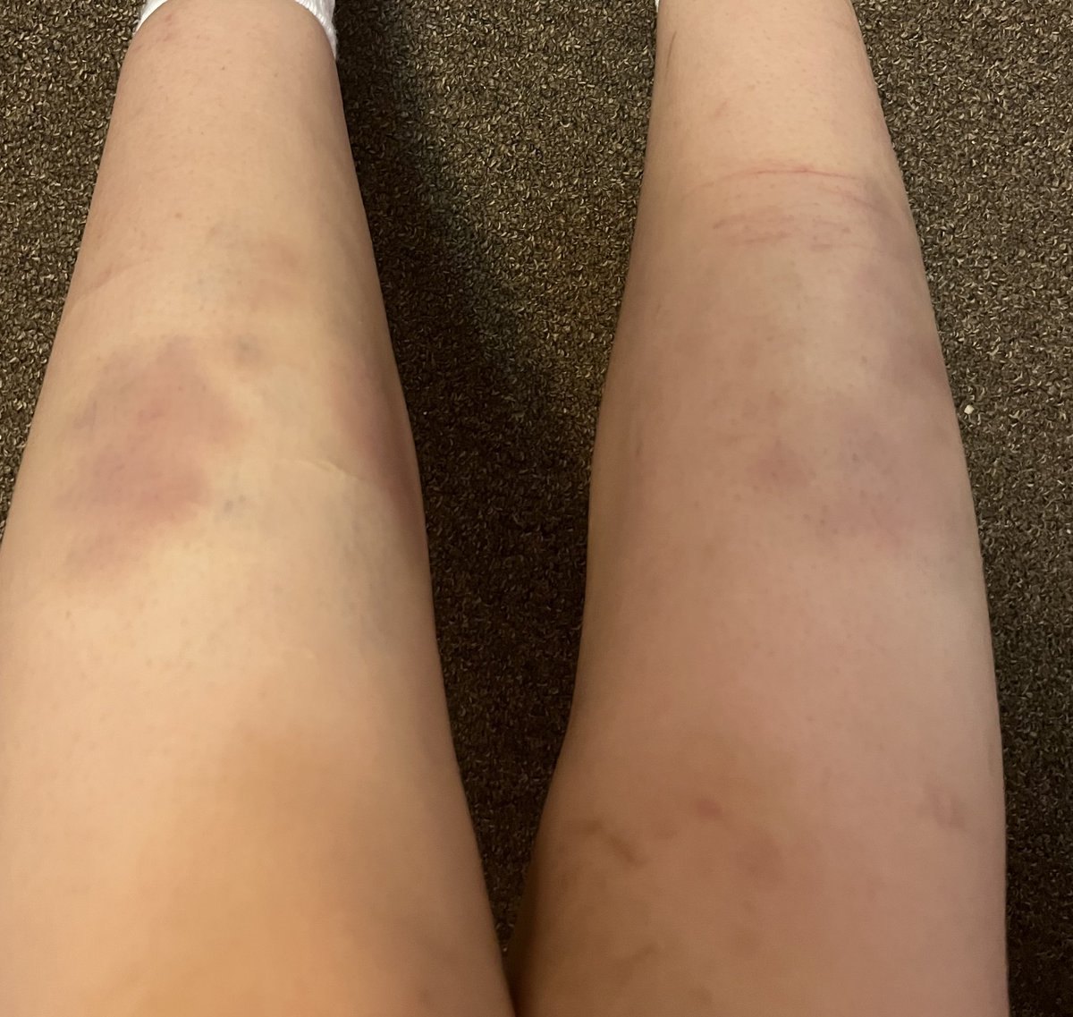 r__x0r's tweet photo. bruising
shtwt https://t.co/lj6PXCor0q