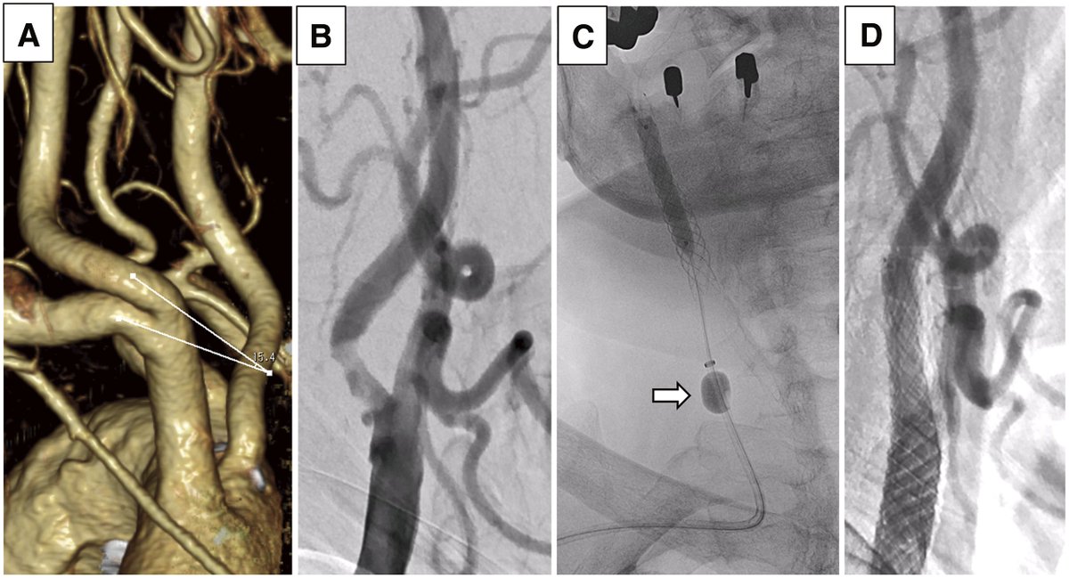 JNET(Journal of Neuroendovascular Therapy) tweet media