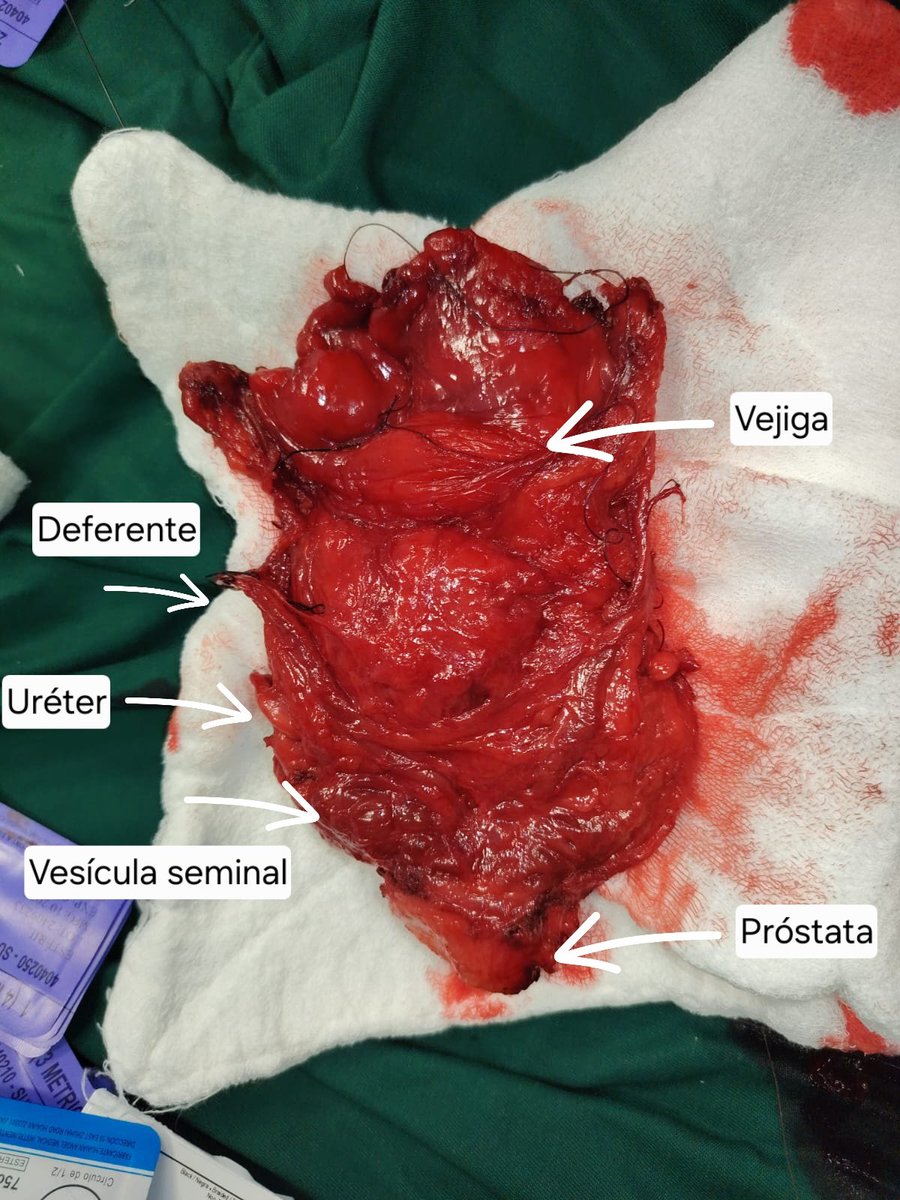 marioduarte1991's tweet photo. Cisto - Prostatectomía radical https://t.co/wqSpV2D8En