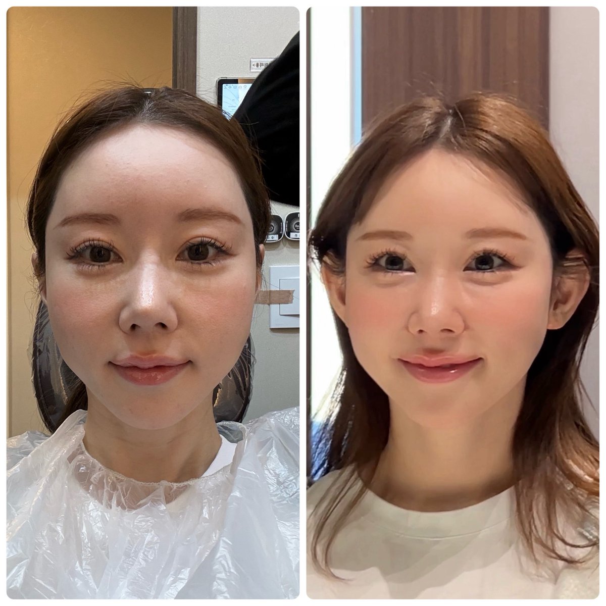 整形ぱんだ🐼ポニーテールリフト、脂肪移植DT中 tweet media