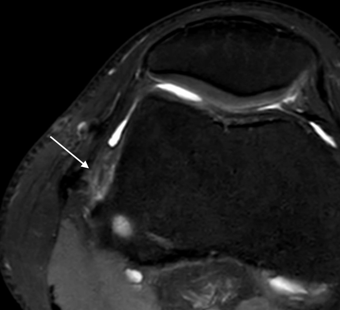 DrJN_SportsMed's tweet photo. Consent✅

Runner, cyclist

ACL reconstruction with LET (lateral extra-articular tenodesis) 1 year ago

Good progress with rehabilitation – however at final stages, intrusive lateral clicking & aching on repetitive 30 degrees flexion into full extension with jogging and more intense bike work

OE - 

Similar picture to ITB friction syndrome; palpation pain close to lateral femoral epicondyle, positive Nobles compression test
Negative fat pad compression
No meniscal or PFJ signs

MRI (axials T2) – 

Oedema / high signal around the LET (in this case, technically a portion of the ITB folded back under the LCL and sutured down)

POCUS video QR code (second half is dynamic flexion / terminal extension assessment) –

Anechoic fluid noted around the LET interface just inferior to the suture (bright) – is this suggestive of inflammation and LET ‘impingement’?

US guided diagnostic injection with LA at this fluid interface 100% abolished pain on incremental treadmill test

It’s possible that impingement is under-reported or recognised; that aside, new lateral knee pain after ACL reconstruction can often be patellofemoral or fat pad in origin due to the change in joint biomechanics and loading patterns, as well as popliteus tendinopathy pain – have these on your radar before thinking about more esoteric causes

Research link –

SANTI group – three times reduced ACL graft failure with LET
https://t.co/cZZtKJUijA