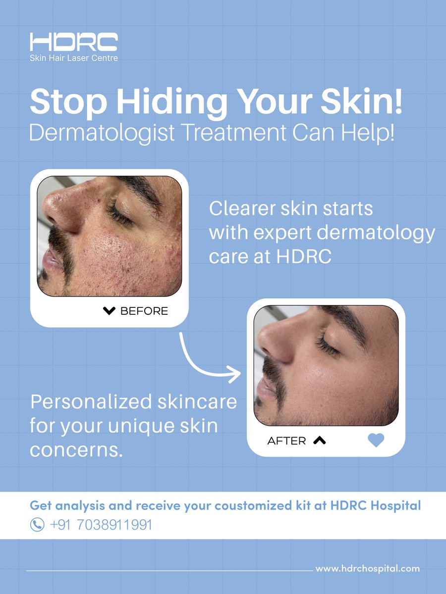 hdrchospital's tweet photo. Acne Before &amp; After | Clearer Skin with Dermatology Care |HDRC Hospital
 With the right dermatology guidance and personalized skincare approach
✨ Get Analysis &amp; Receive Your Customized Care Kit
📞 +91 7038911991
🌐 https://t.co/U7fcQTpCPg
 
#acne #skin #dermatology #skincarekit https://t.co/6TCgttzKcA