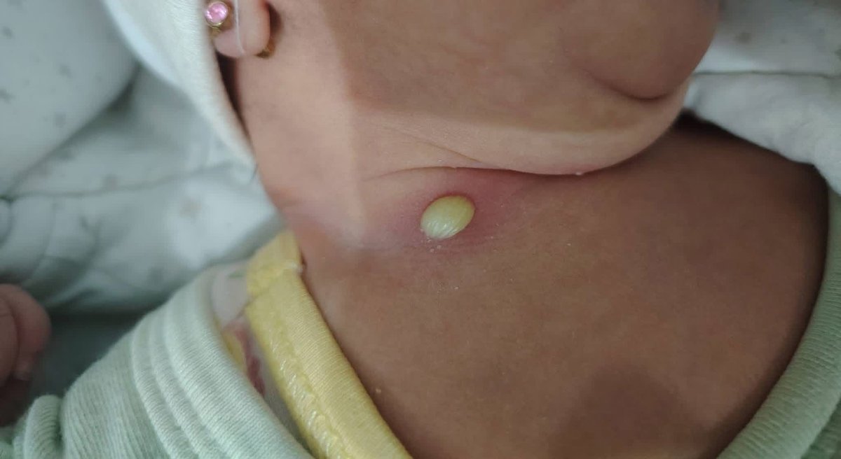 I WILL DIE😭 

Unfortunately, my poor little my daughter  body is full of pimples and I can't do anything for her. She urgently needs your help to provide tr

3 replies — even dots — can break the
 algorithm😭

gofund.me/62fb9062d