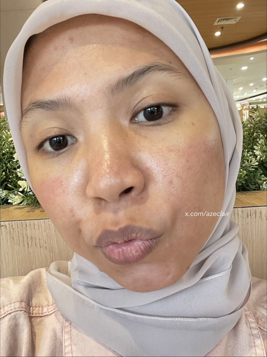 azeclair's tweet photo. nurut kata dokter buat fokus “calming skin” and tadaa~

my skin gets better🥺🫰🏻 https://t.co/RdLY8Qgy3X