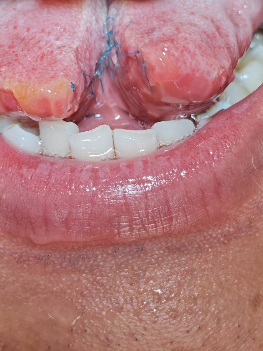 acoolda's tweet photo. tongue split.分舌的第四天，想问：这样看舌头恶不恶心？ https://t.co/77ptVY035F