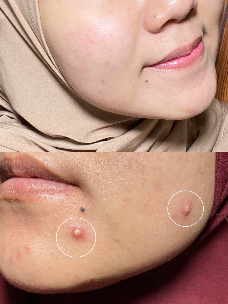 riskyrizukii's tweet photo. Alhamdulillah akhirnya jerawatku sudah mulai calming dan hilang 🤩🫶

Seminggu lagi lebaran, ngejaga banget biar jerawat mendingan dan hilang jadi ga perlu ovt deh! https://t.co/qZci0iVYf9