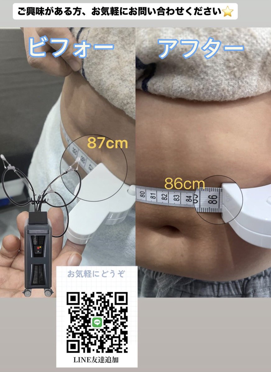 Keylaser_Rosie's tweet photo. 施術直後から効果を実感
【即効性】 5分だけの施術でウエストが最大1cm細くなる

気になる方はLINEから‼️

#痩身 #痩身機器 #ondapro #ウエスト #脂肪溶解 #クリニック開業
#美容機器導入
#導入サポート https://t.co/nwNIJhpjXS