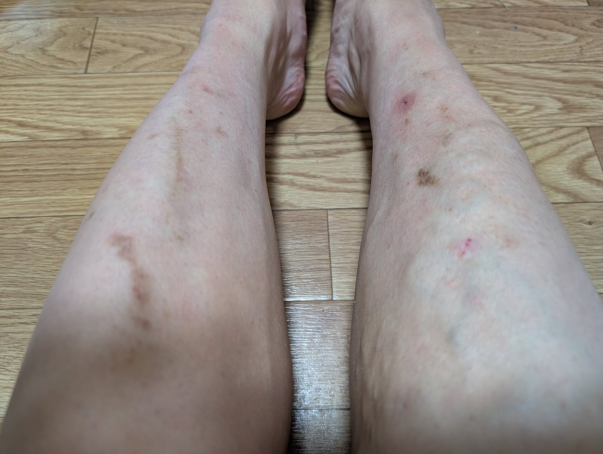 ototoreader's tweet photo. さっきチャリ漕ぎ踏み外して
勢い良く空回ったペダルに脛ぶつけてん

俺の人生スネのケガ多過ぎね？
弁慶ならとっくに死んどるから https://t.co/zAcuTWK1C5