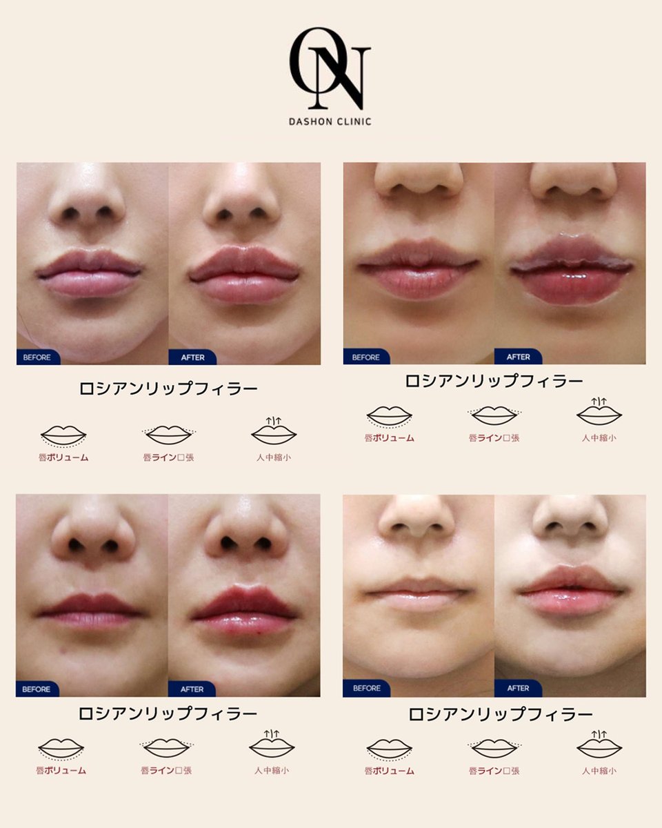 dashon_jpn's tweet photo. ダシオンクリニック💙

自然で可愛いボリューム感✨
ロシアンリップフィラー＆涙袋フィラーで
立体感のある顔立ちに💉

💌 日本語対応OK
LINE ID @glowbridge 

#韓国美容 #韓国フィラー #ロシアンリップ #涙袋フィラー #江南美容 #韓国クリニック #ダションクリニック https://t.co/4FIjlz0rCC