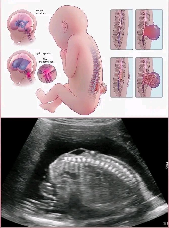 Neversleeps_HQ's tweet photo. 26 Weeks pregnancy patient History
What is the fetal anomaly?
#ultrasound #pregnancy #doctor #post #baby #mother #ultrasoundscan #pregnant https://t.co/Z24BQbuPug