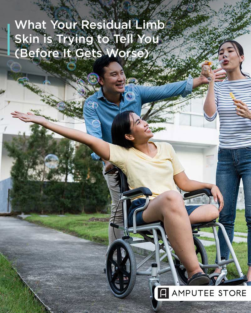 amputeestore's tweet image. Your skin can reveal issues with your prosthetic socket. Persistent redness, irritation, or trapped moisture may indicate problems with fit, friction, or materials. A quick two-minute daily skin check can help catch issues early. zurl.co/udvZ9 #amputee #skinhealth