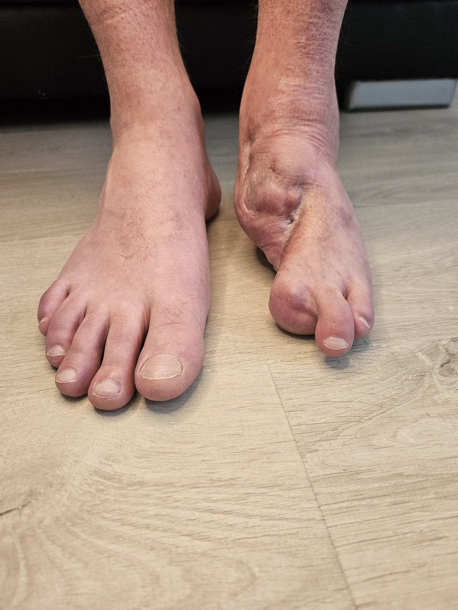 halffoodhero's tweet photo. Normal kann jeder. 😉 Wir lieben den Kontrast meiner Füße und zeigen euch ab jetzt alles über unsere Reise und meine Einzigartigkeit. 👣✨
​Den Link zu unserem privaten Bereich findet ihr in der Bio!
​#LimbDifference #FootFetish #NewAccount #feetِ https://t.co/xwCTZ0dEZZ