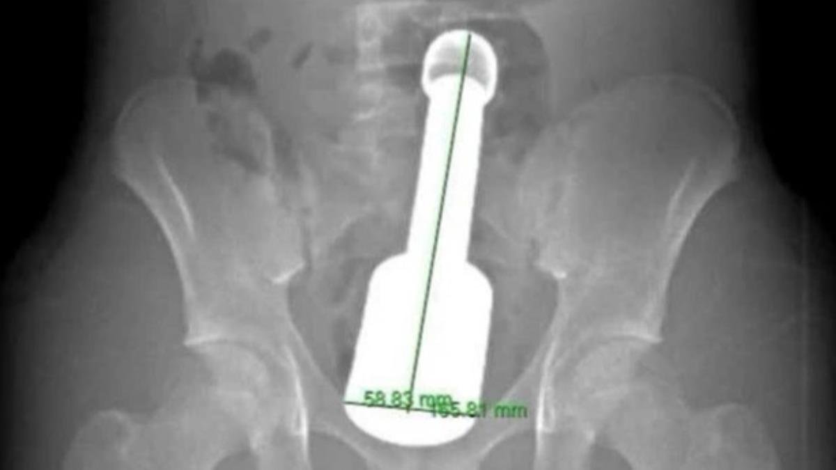 好奇心惹禍！少年「18cm金屬棒」卡體內
我草 小弟 這玩意兒不是這樣玩的啊